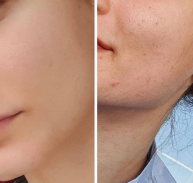 سرم ضدلک پوست