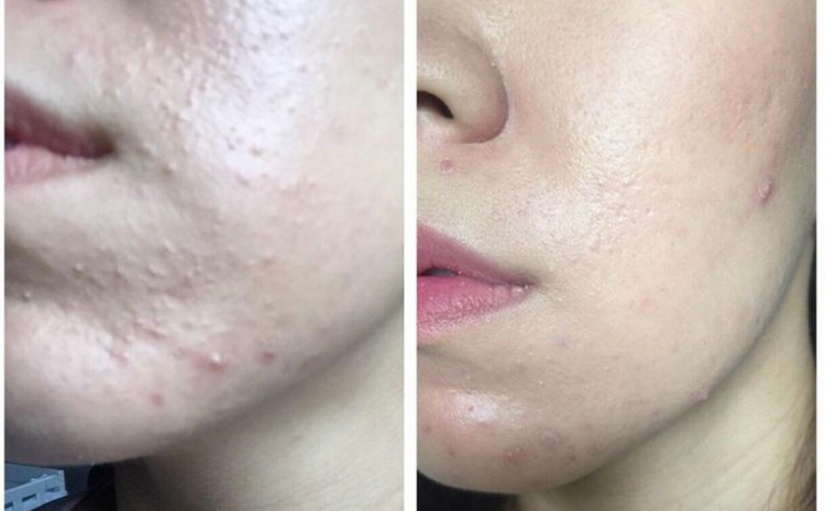 فوم شستشو ضدجوش