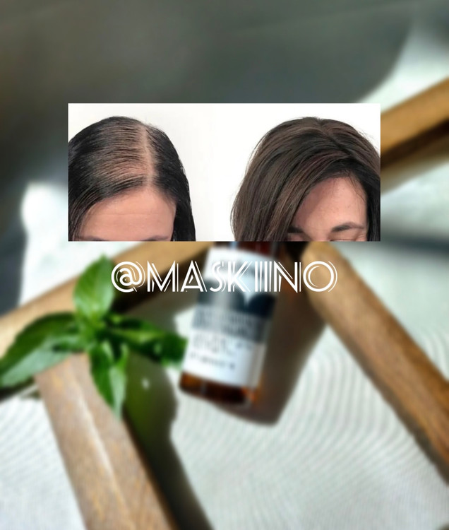 ریزش مو ارثی