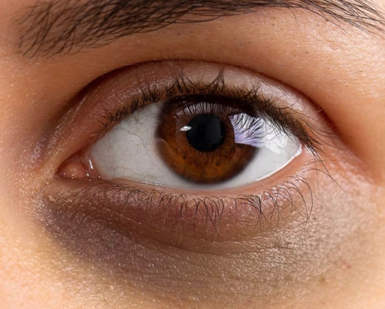 تیرگی دورچشم